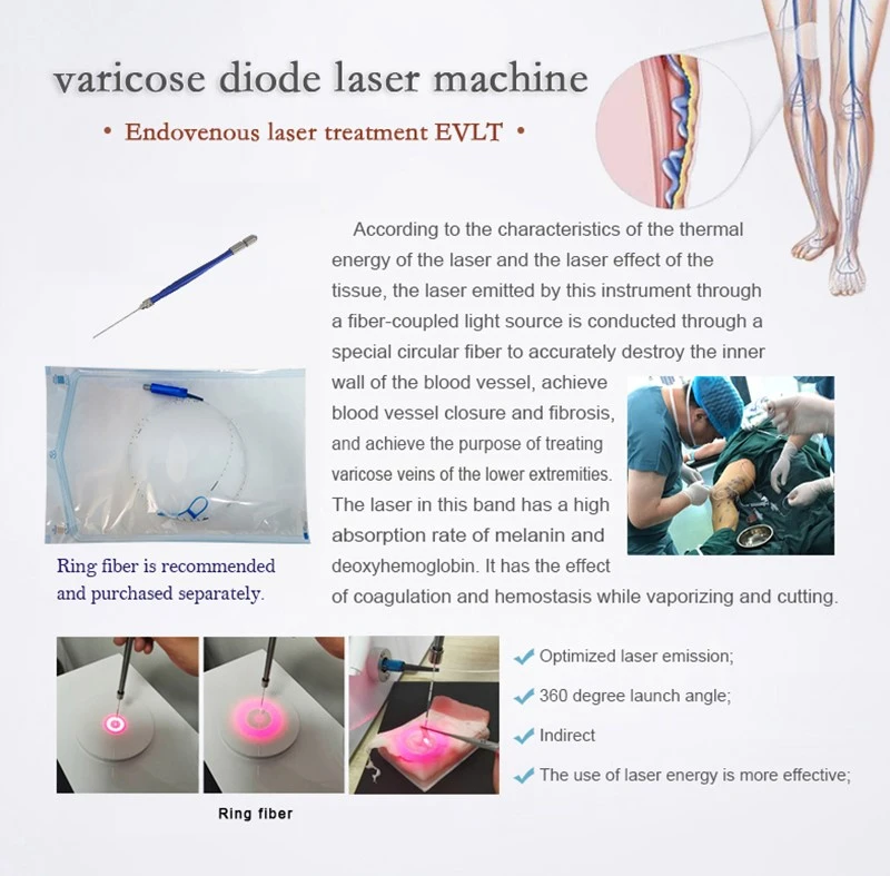 Varicose-vein-details Varicose-vein-details